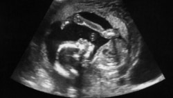 Ультразвуковая диагностика плода