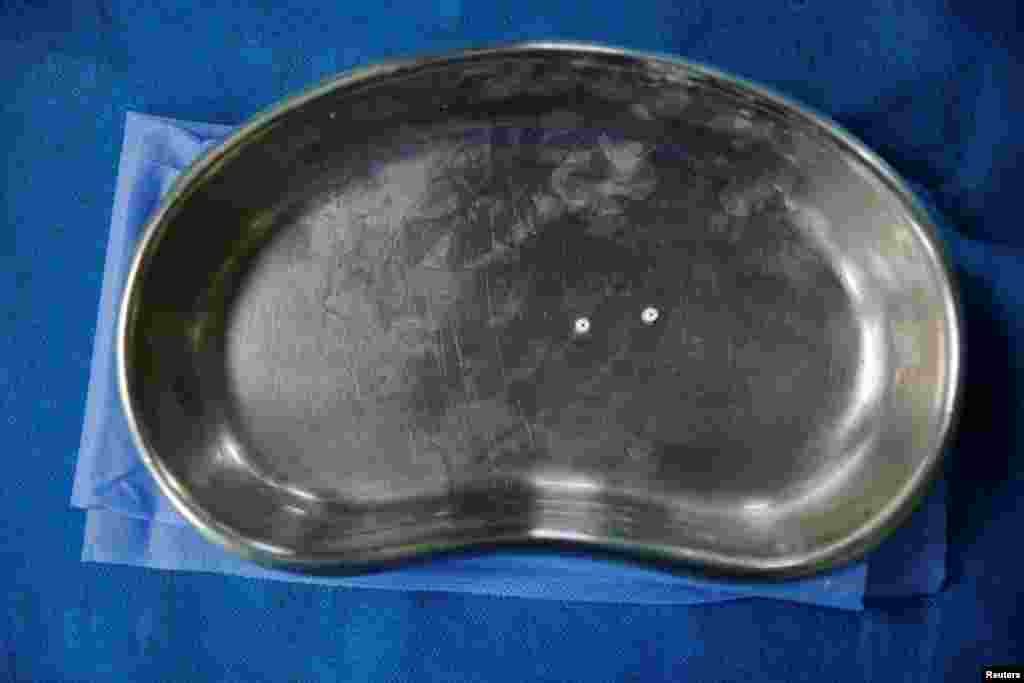 Стерилизацию проводят с помощью эластичных "колец Юна". Ими перетягивают фаллопиевые трубы, чтобы сделать оплодотворение невозможным